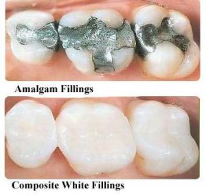 white fillings